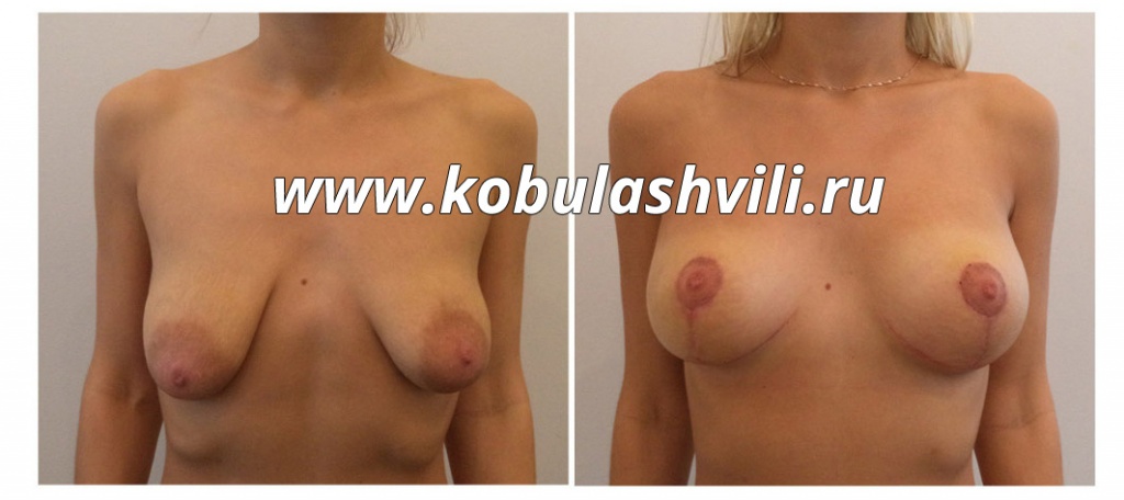 Подтяжка груди после родов фото до и после. Хирург Тимур Кобулашвили