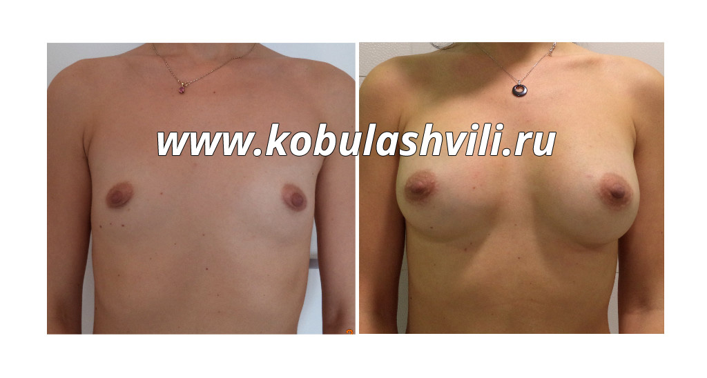 Увеличение груди имплантами. Фото до и после. Хирург Тимур Кобулашвили