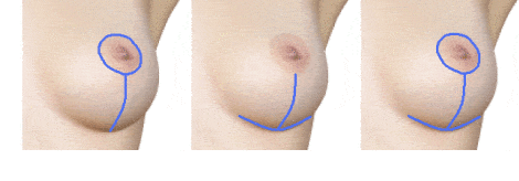 Схема разрезов при подтяжке груди