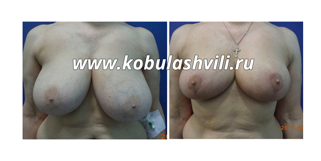 Уменьшение груди. Фото до и после. Хирург Тимур Кобулашвили