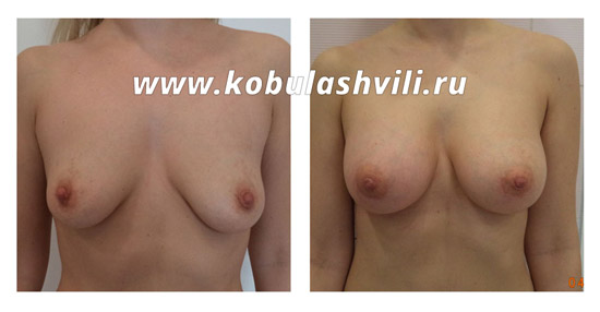 Увеличение груди Кобулашвили