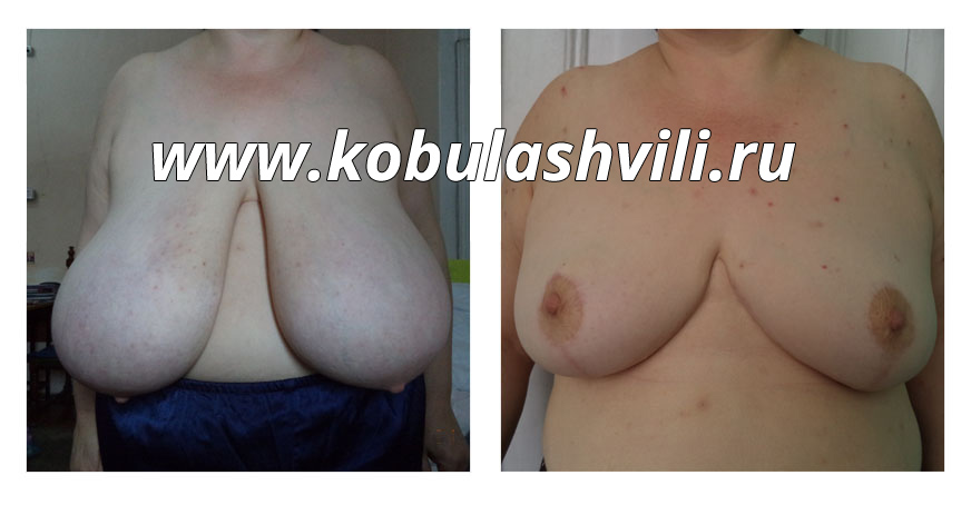 Уменьшение груди операция до и после Тимур Кобулашвили